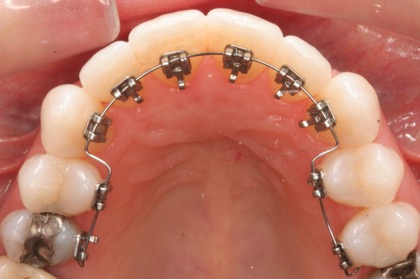矯正装置を歯の裏側に付ける矯正治療